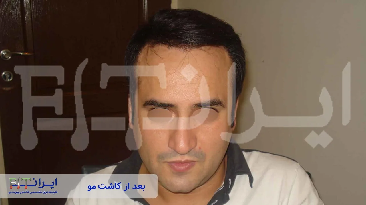 Scalp hair transplant after, case 1 published by Iran Fit Centre