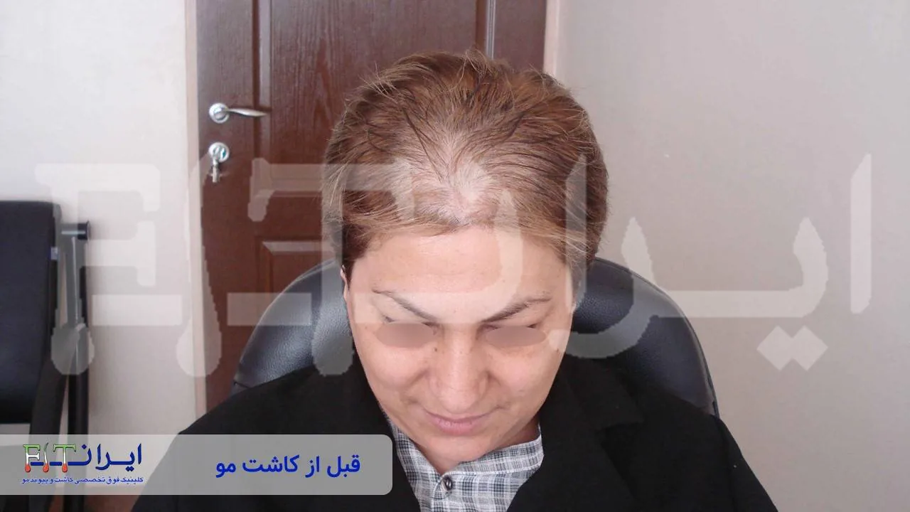 Women’s scalp hair transplant before, case 2 published by Iran Fit Centre