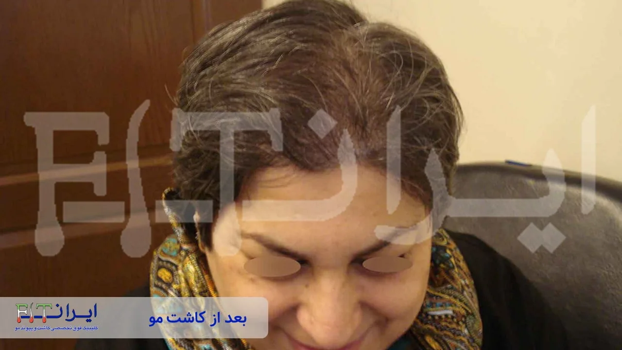Women’s scalp hair transplant after, case 2 published by Iran Fit Centre