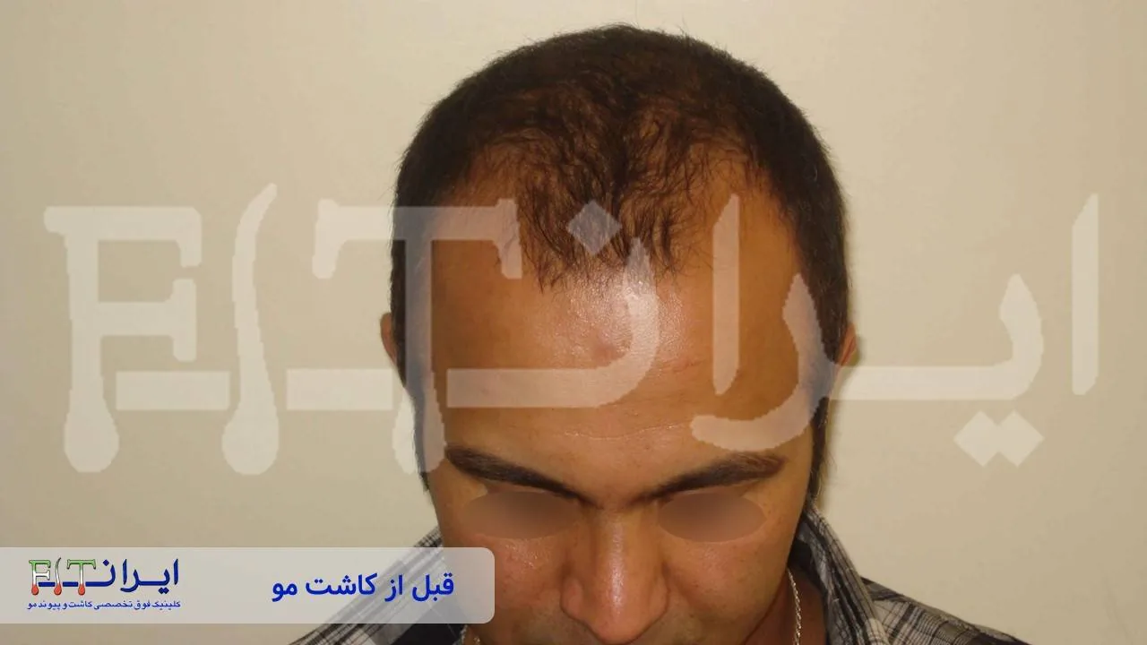 Scalp hair transplant before, case 3 published by Iran Fit Centre