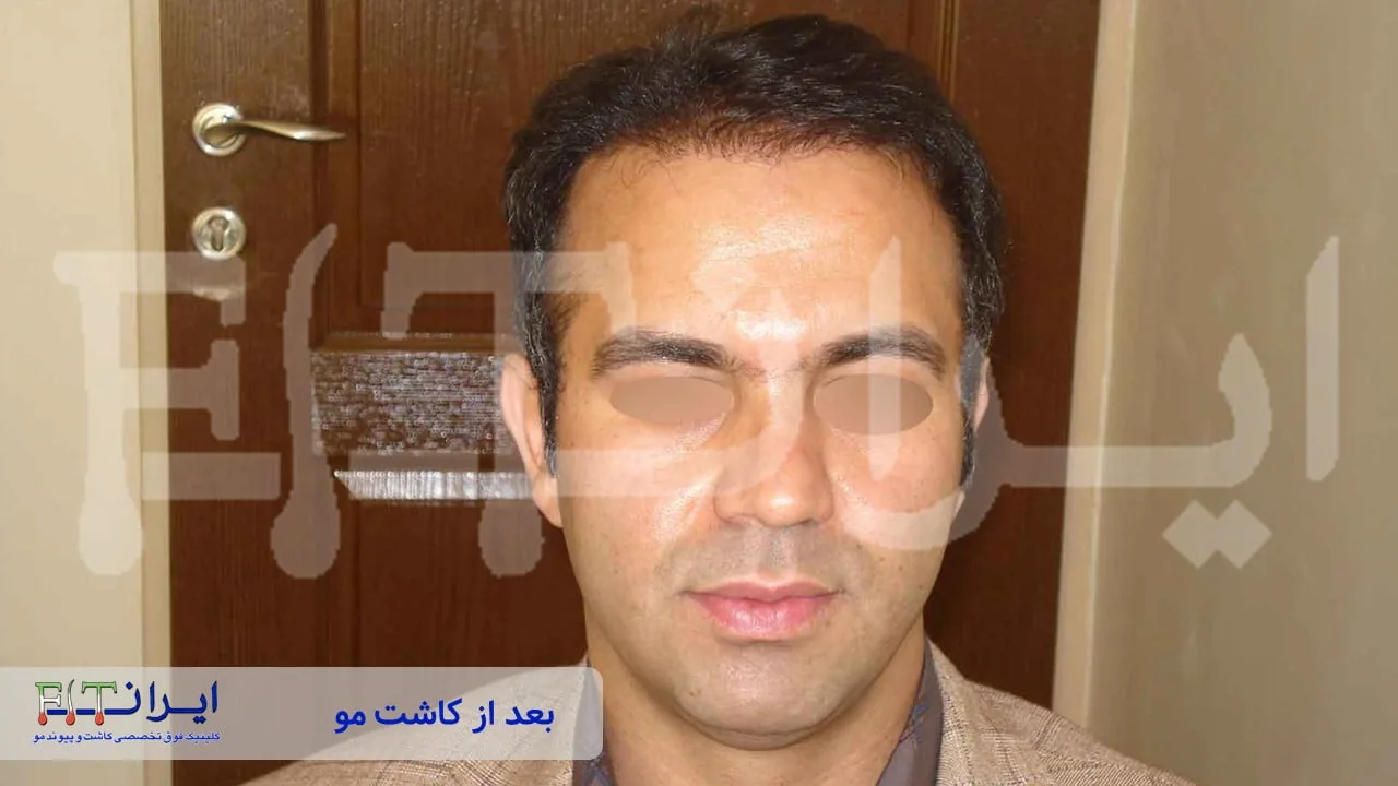 Scalp hair transplant after, case 3 published by Iran Fit Centre