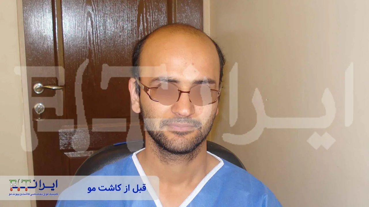 Scalp hair transplant before, case 4 published by Iran Fit Centre