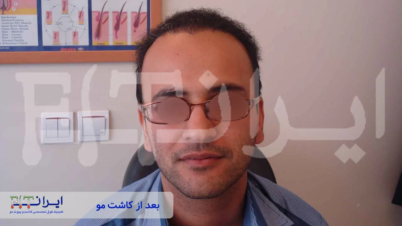 Scalp hair transplant after, case 4 published by Iran Fit Centre