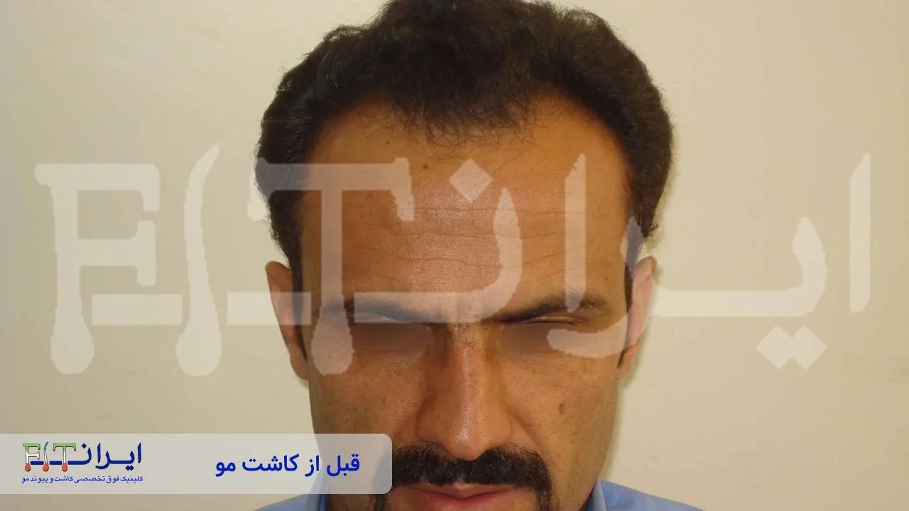 Scalp hair transplant before, case 5 published by Iran Fit Centre
