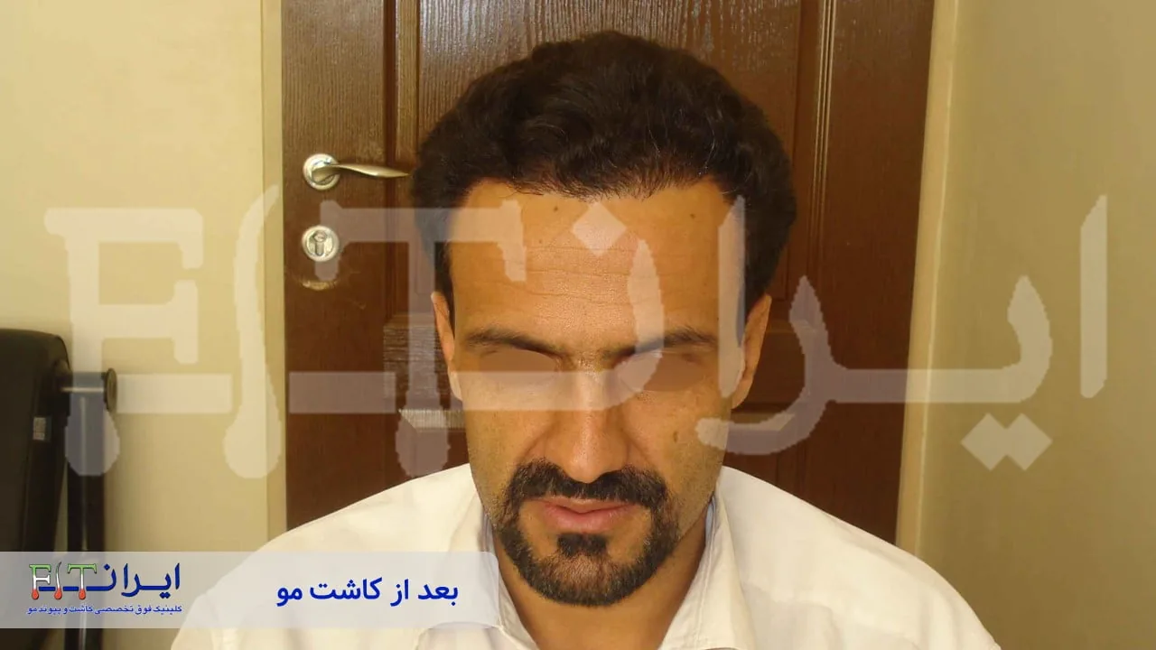 Scalp hair transplant after, case 5 published by Iran Fit Centre