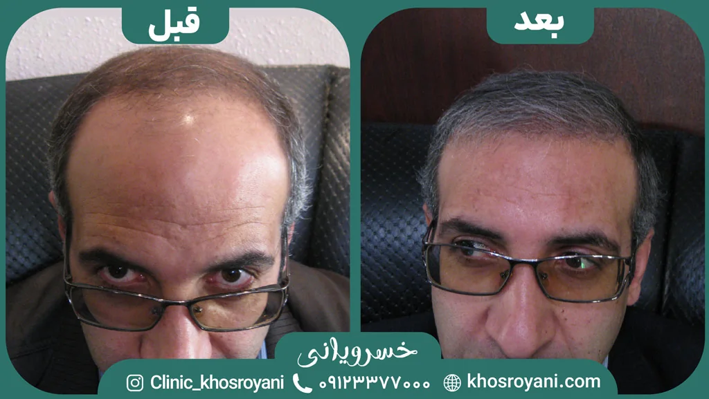 Scalp hair transplant before-and-after comparison, case 3 published by Khosroyani Clinic