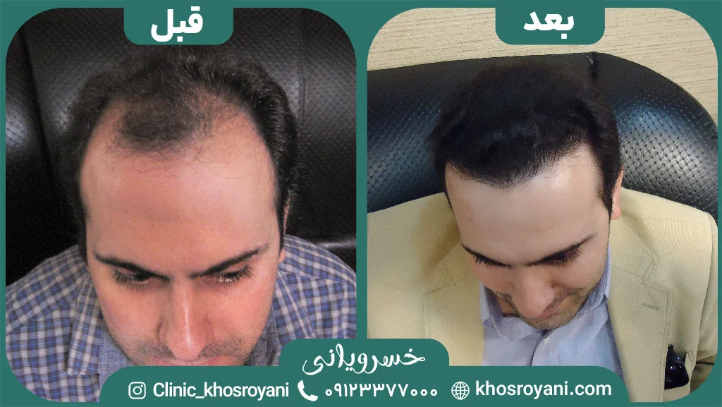 Scalp hair transplant before-and-after comparison, case 1 published by Khosroyani Clinic