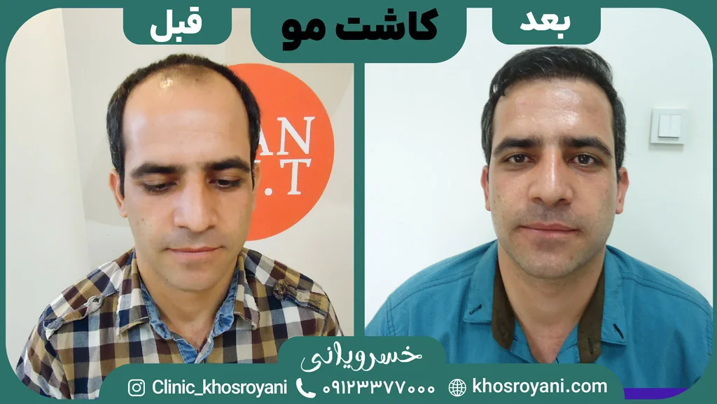 Scalp hair transplant before-and-after comparison, case 5 published by Khosroyani Clinic