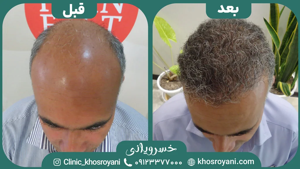 Scalp hair transplant before-and-after comparison, case 4 published by Khosroyani Clinic