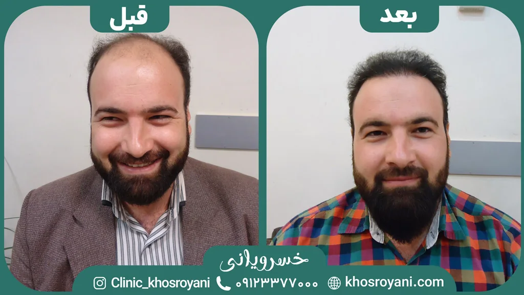 Scalp hair transplant before-and-after comparison, case 2 published by Khosroyani Clinic
