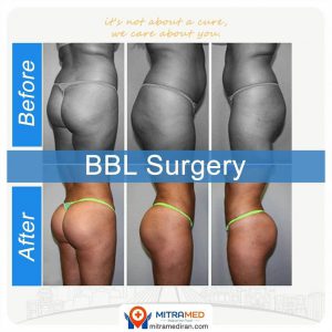 Brazilian butt lift before and after case showing front, side and back views; source: MITRAMED gallery