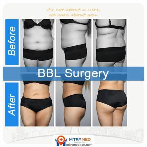 Brazilian butt lift before and after case showing body contour changes; source: MITRAMED gallery