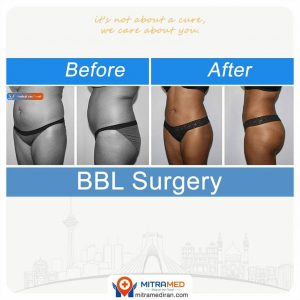Brazilian butt lift before and after case with side and rear views; source: MITRAMED gallery