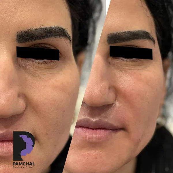 مقارنة منشورة لمنطقة تجاعيد التعبير وحقن السم البوتوليني، مثال 05، عيادة بامچال في طهران