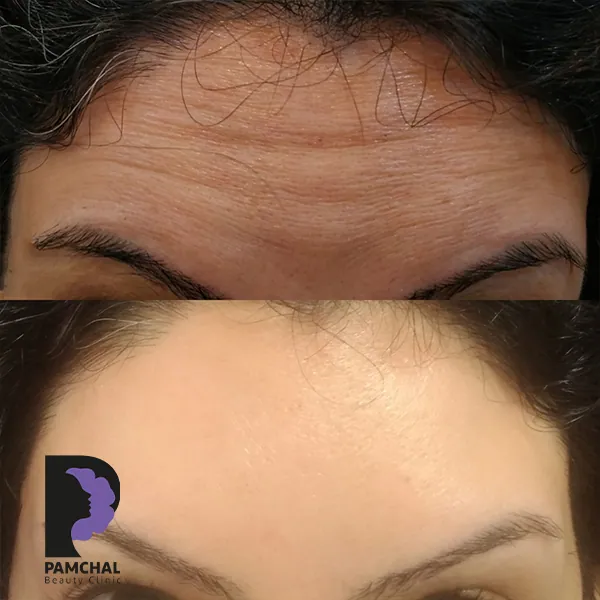 مقارنة منشورة لمنطقة تجاعيد التعبير وحقن السم البوتوليني، مثال 08، عيادة بامچال في طهران