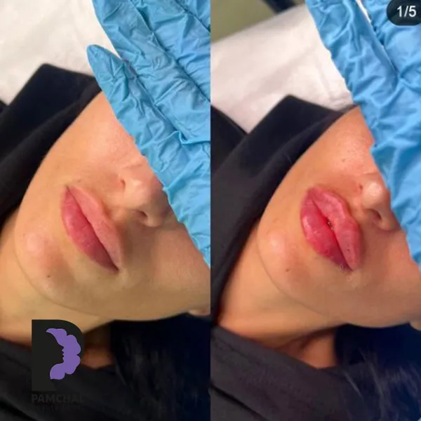 Lip filler, published example 2 from Pamchal Clinic, Tehran