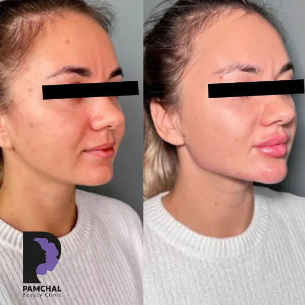 مقارنة منشورة لمنطقة الخدود ومنتصف الوجه، مثال 03، عيادة بامچال في طهران