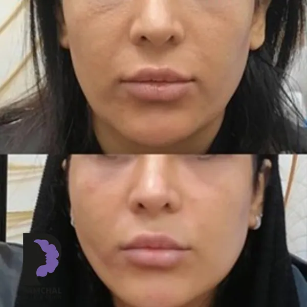 مقارنة منشورة لمنطقة الخدود ومنتصف الوجه، مثال 11، عيادة بامچال في طهران