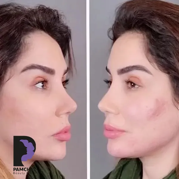 مقارنة منشورة لمنطقة الخدود ومنتصف الوجه، مثال 14، عيادة بامچال في طهران