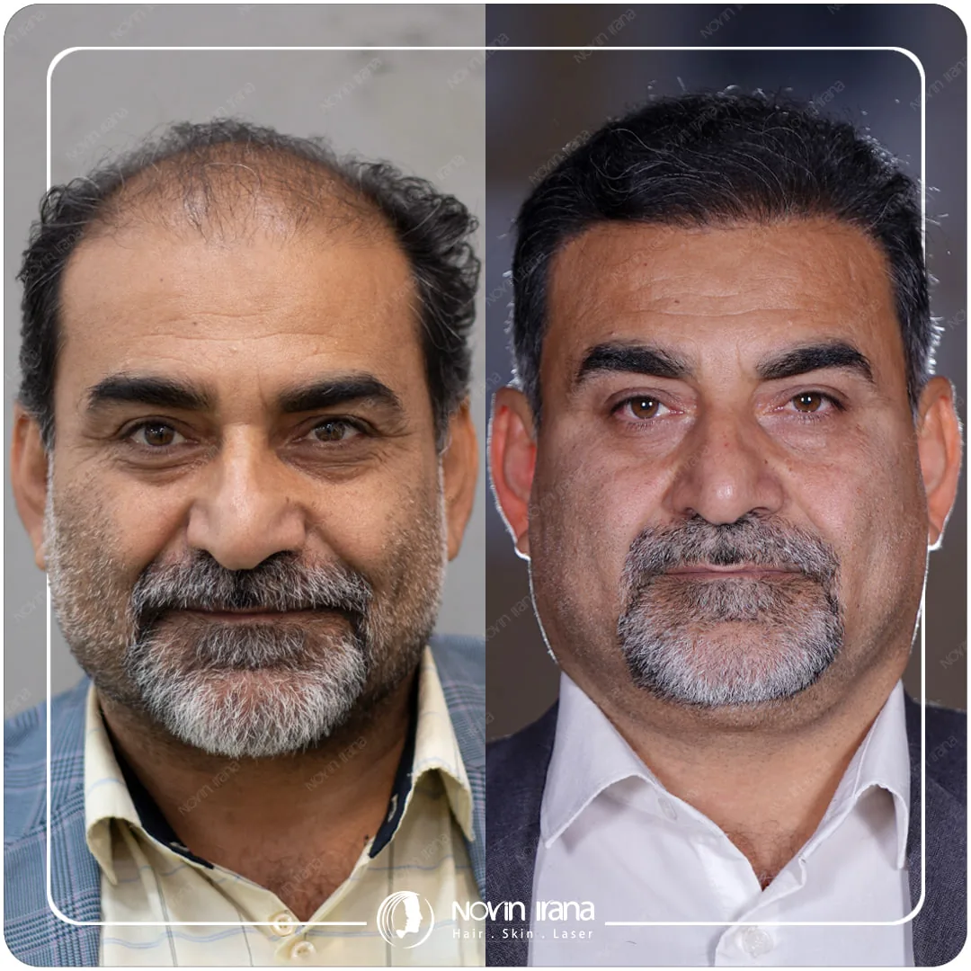 Scalp hair transplant before-and-after comparison, case 1 published by Novin Irana Clinic