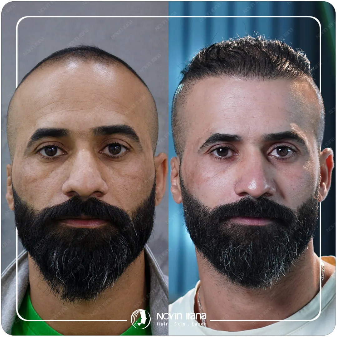 Scalp hair transplant before-and-after comparison, case 3 published by Novin Irana Clinic