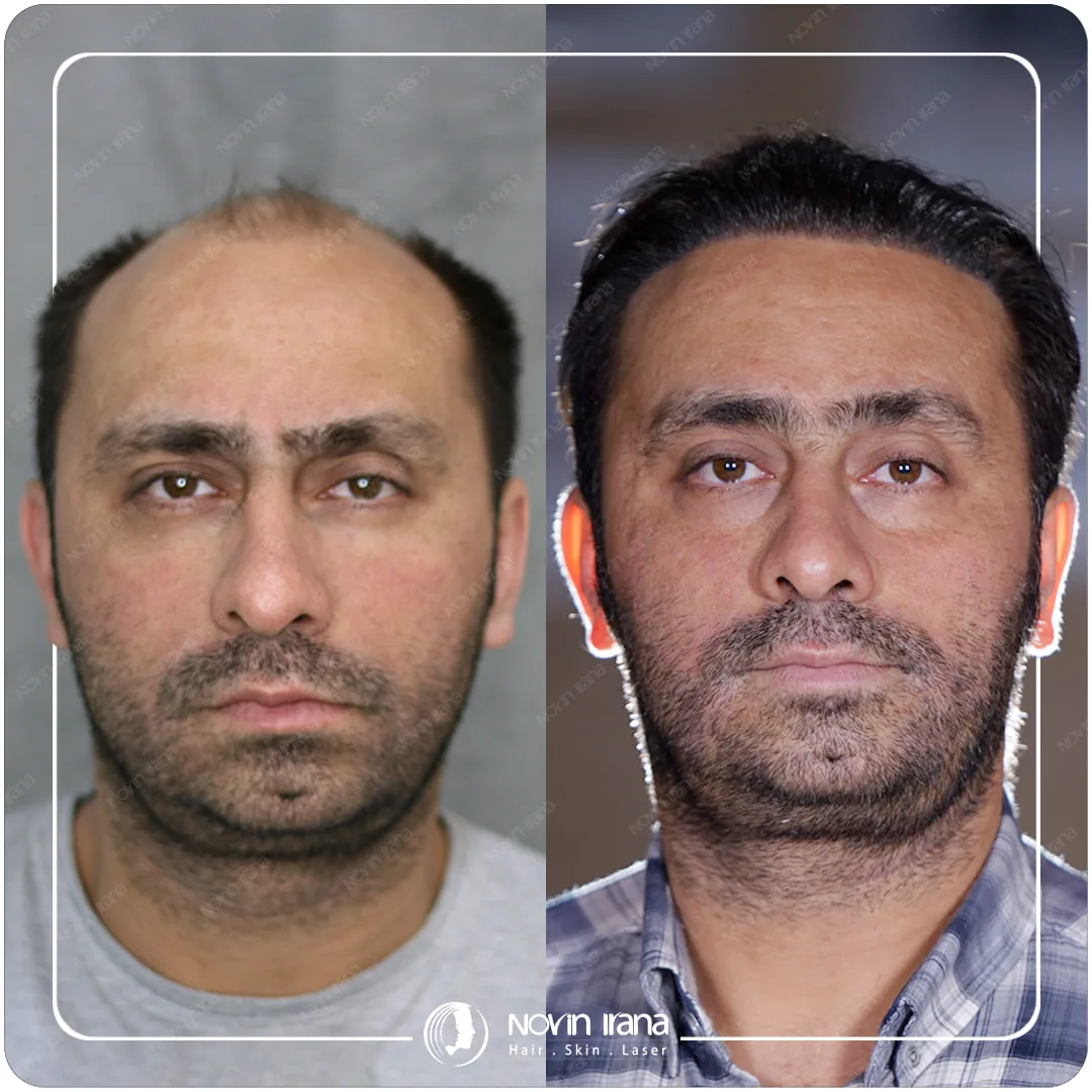 Scalp hair transplant before-and-after comparison, case 4 published by Novin Irana Clinic