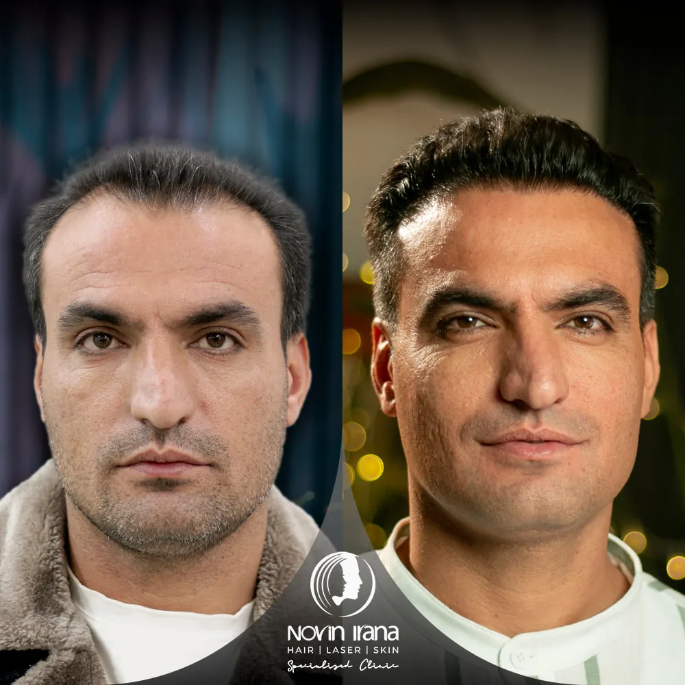 Scalp hair transplant before-and-after comparison, case 5 published by Novin Irana Clinic
