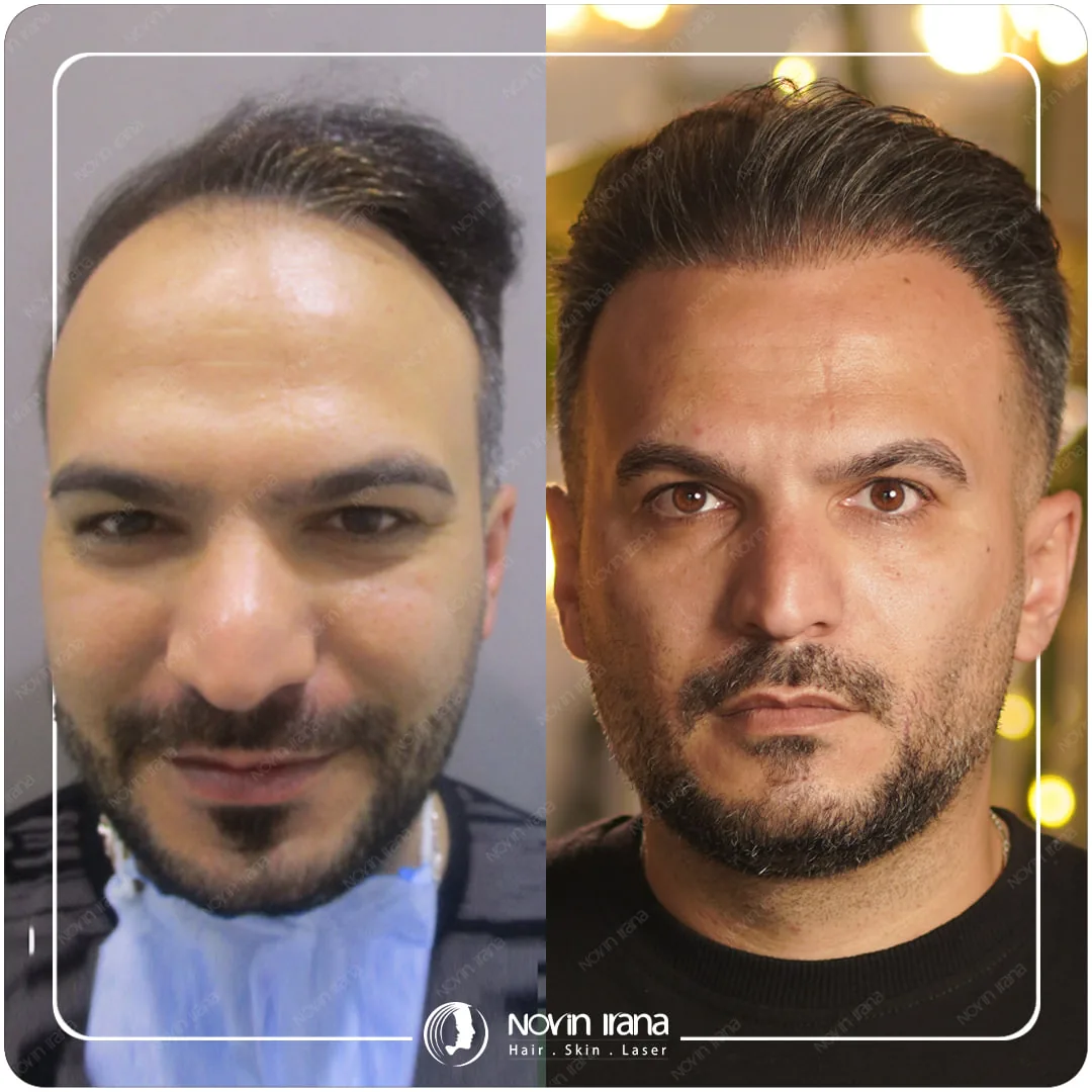 Scalp hair transplant before-and-after comparison, case 2 published by Novin Irana Clinic