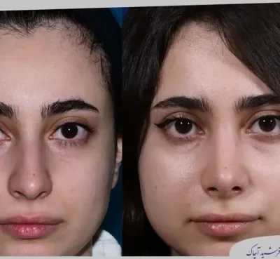 مقارنة قبل وبعد جراحة تجميل الأنف، صورة رقم 01 من معرض الدكتور فرشيد آچاك