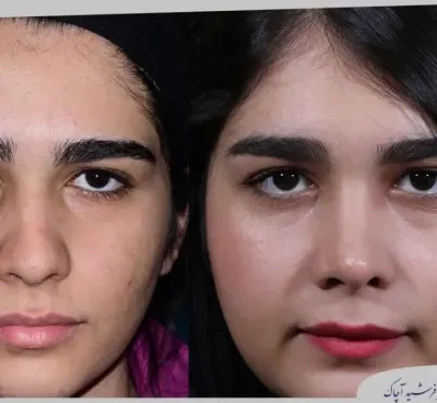 مقارنة قبل وبعد جراحة تجميل الأنف، صورة رقم 02 من معرض الدكتور فرشيد آچاك