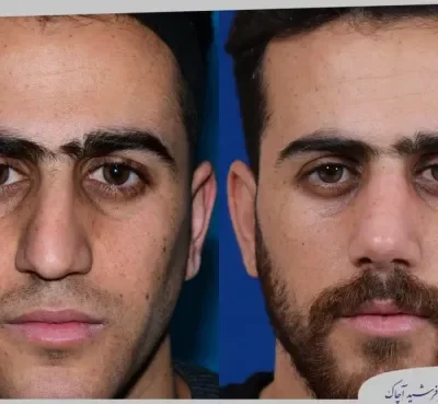 مقارنة قبل وبعد جراحة تجميل الأنف، صورة رقم 03 من معرض الدكتور فرشيد آچاك