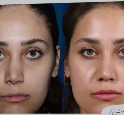 مقارنة قبل وبعد جراحة تجميل الأنف، صورة رقم 04 من معرض الدكتور فرشيد آچاك