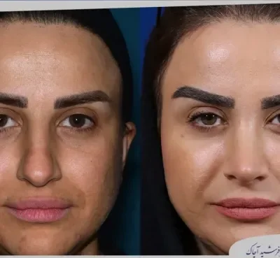 مقارنة قبل وبعد جراحة تجميل الأنف، صورة رقم 05 من معرض الدكتور فرشيد آچاك