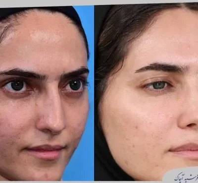 مقارنة قبل وبعد جراحة تجميل الأنف، صورة رقم 06 من معرض الدكتور فرشيد آچاك