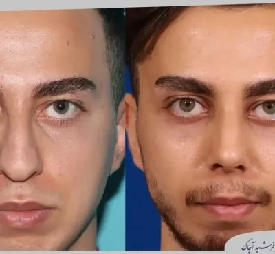 مقارنة قبل وبعد جراحة تجميل الأنف، صورة رقم 07 من معرض الدكتور فرشيد آچاك