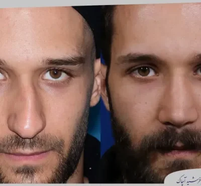 مقارنة قبل وبعد جراحة تجميل الأنف، صورة رقم 08 من معرض الدكتور فرشيد آچاك