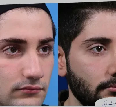 مقارنة قبل وبعد جراحة تجميل الأنف، صورة رقم 09 من معرض الدكتور فرشيد آچاك