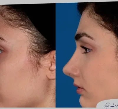 مقارنة قبل وبعد جراحة تجميل الأنف، صورة رقم 10 من معرض الدكتور فرشيد آچاك