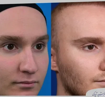 مقارنة قبل وبعد جراحة تجميل الأنف، صورة رقم 11 من معرض الدكتور فرشيد آچاك