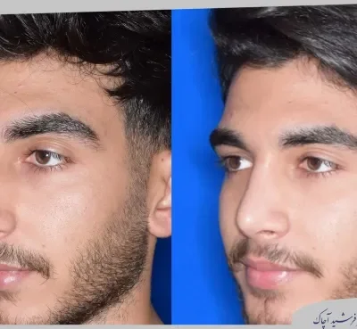 مقارنة قبل وبعد جراحة تجميل الأنف، صورة رقم 12 من معرض الدكتور فرشيد آچاك