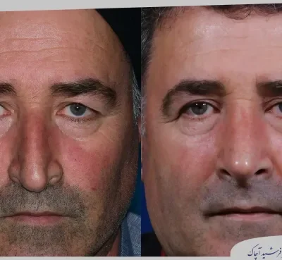 مقارنة قبل وبعد جراحة تجميل الأنف، صورة رقم 13 من معرض الدكتور فرشيد آچاك