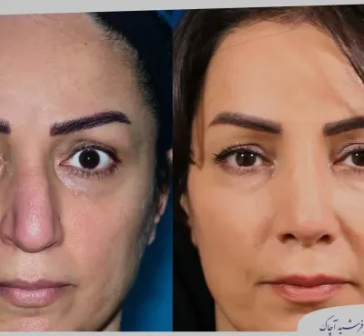 مقارنة قبل وبعد جراحة تجميل الأنف، صورة رقم 14 من معرض الدكتور فرشيد آچاك