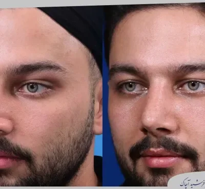 مقارنة قبل وبعد جراحة تجميل الأنف، صورة رقم 15 من معرض الدكتور فرشيد آچاك