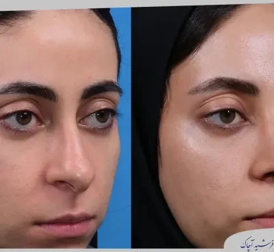 مقارنة قبل وبعد جراحة تجميل الأنف، صورة رقم 16 من معرض الدكتور فرشيد آچاك