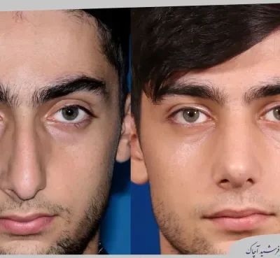 مقارنة قبل وبعد جراحة تجميل الأنف، صورة رقم 17 من معرض الدكتور فرشيد آچاك