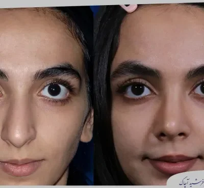 مقارنة قبل وبعد جراحة تجميل الأنف، صورة رقم 18 من معرض الدكتور فرشيد آچاك
