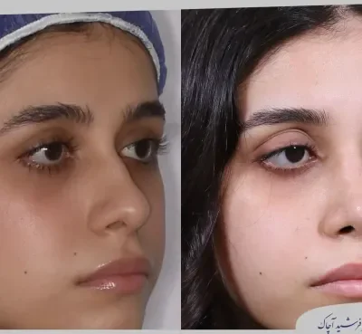 مقارنة قبل وبعد جراحة تجميل الأنف، صورة رقم 19 من معرض الدكتور فرشيد آچاك