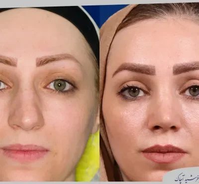مقارنة قبل وبعد جراحة تجميل الأنف، صورة رقم 20 من معرض الدكتور فرشيد آچاك