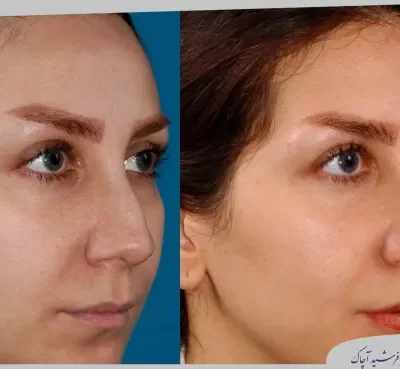 مقارنة قبل وبعد جراحة تجميل الأنف، صورة رقم 21 من معرض الدكتور فرشيد آچاك