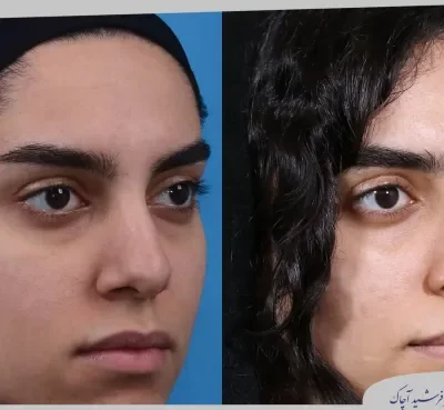 مقارنة قبل وبعد جراحة تجميل الأنف، صورة رقم 22 من معرض الدكتور فرشيد آچاك